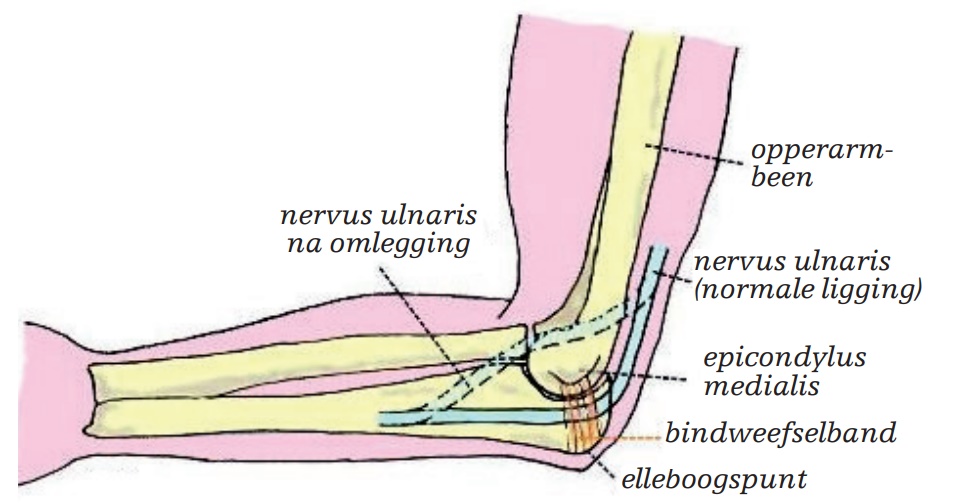 Sulcus nervi ulnaris syndroom