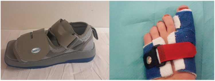 Hallux valgus schoen na operatie new arrivals