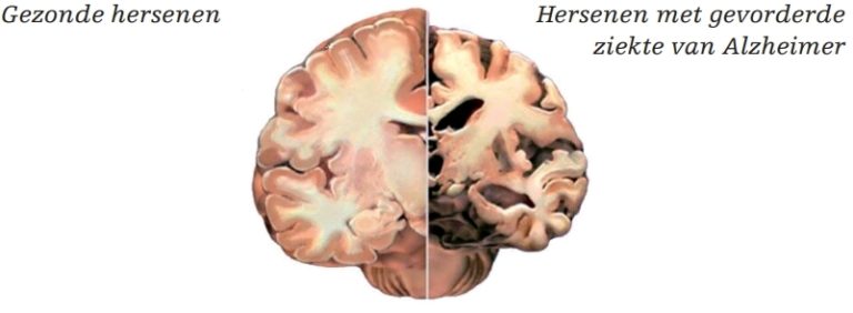 Dementie Ziekte Van Alzheimer Tergooi Mc